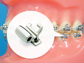buccal tube