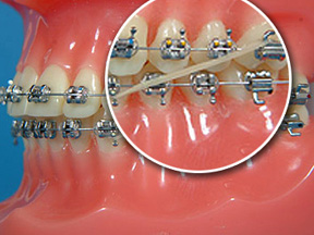 elastics
