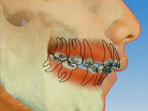extractions